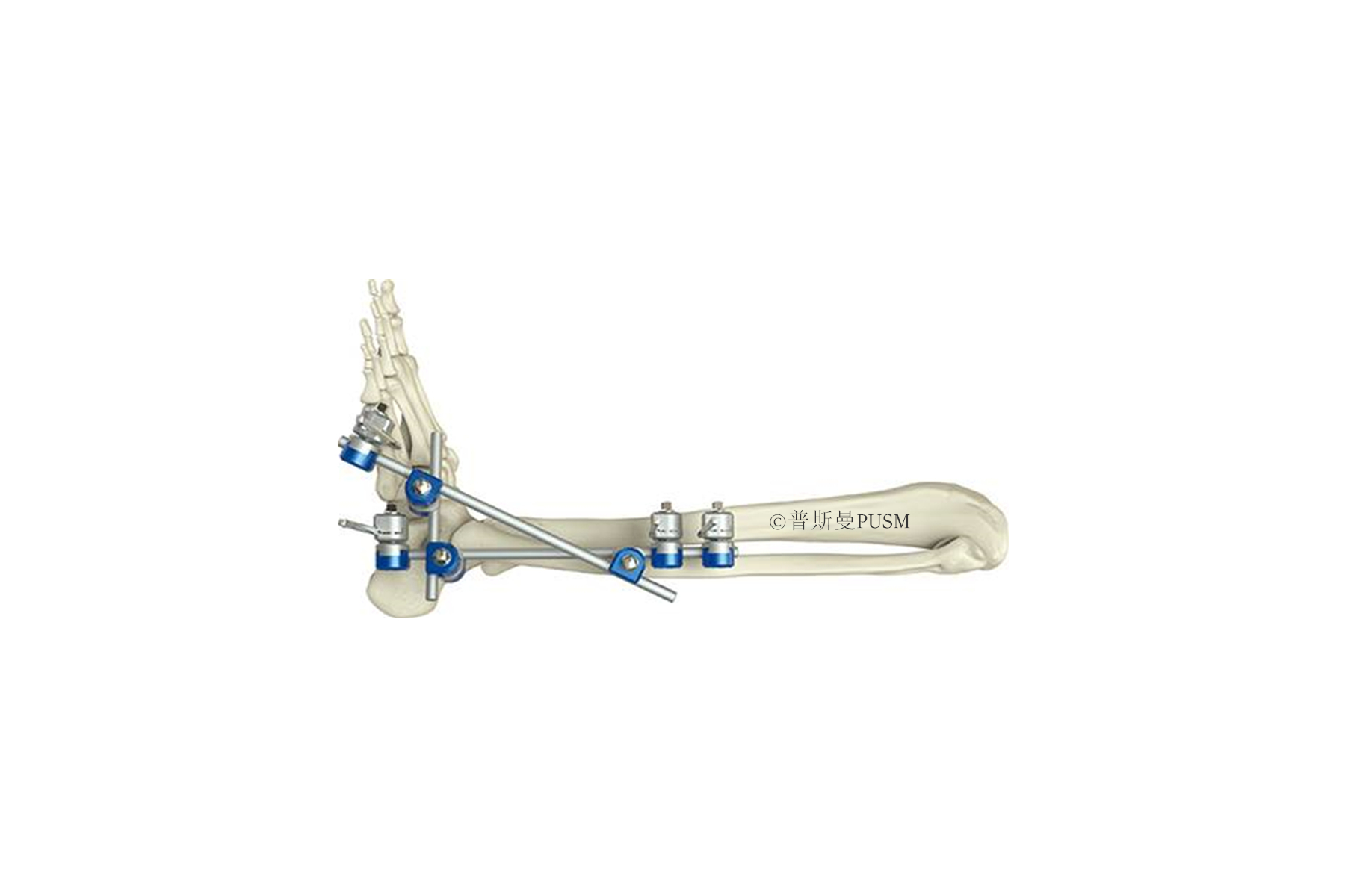 SPUSM-H17 Ankle Joint External Fixator