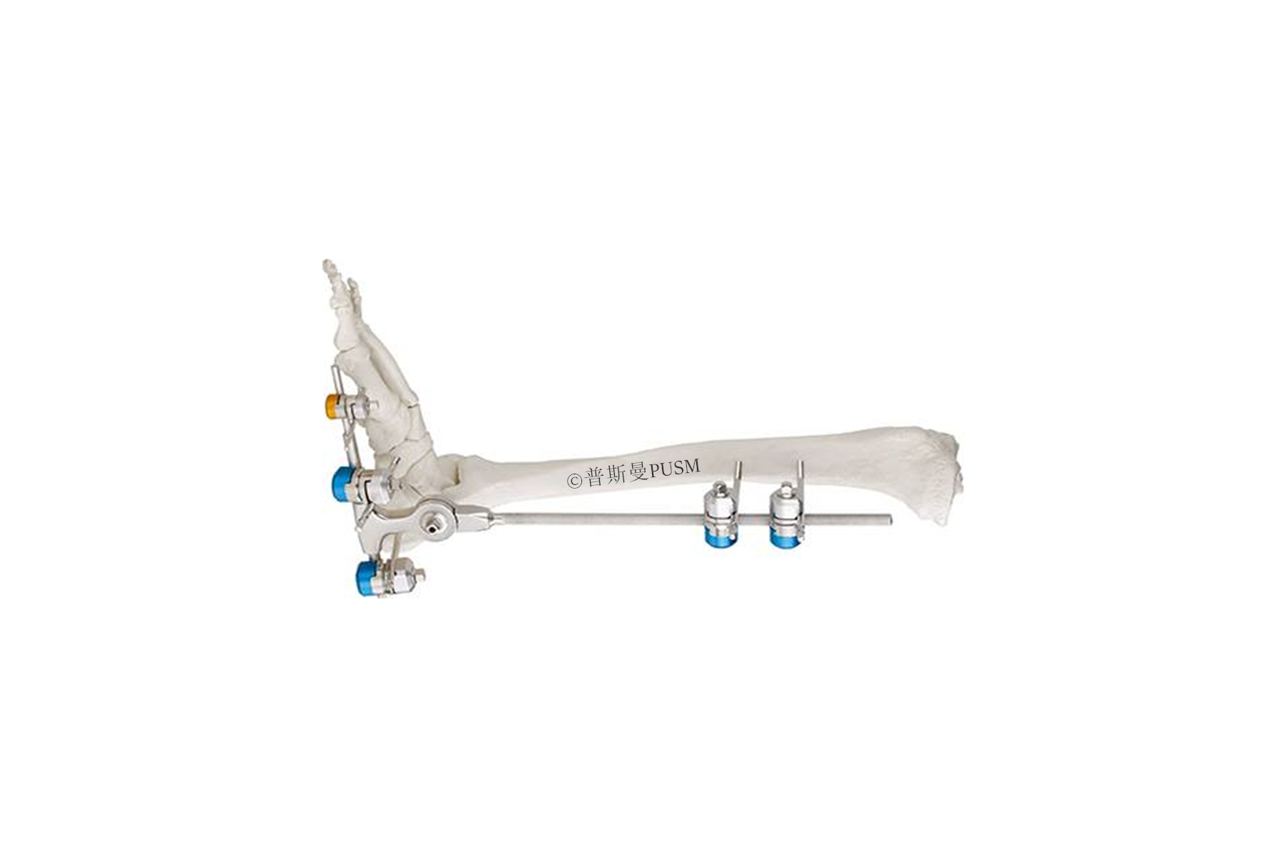 SPUSM-H19 Ankle Joint External Fixator