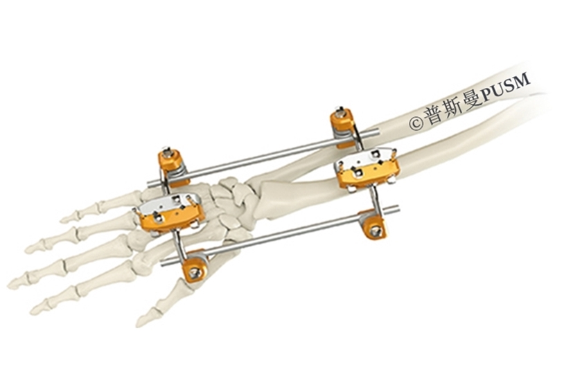 SCombinational External Fixator(A Type Upper Limb)