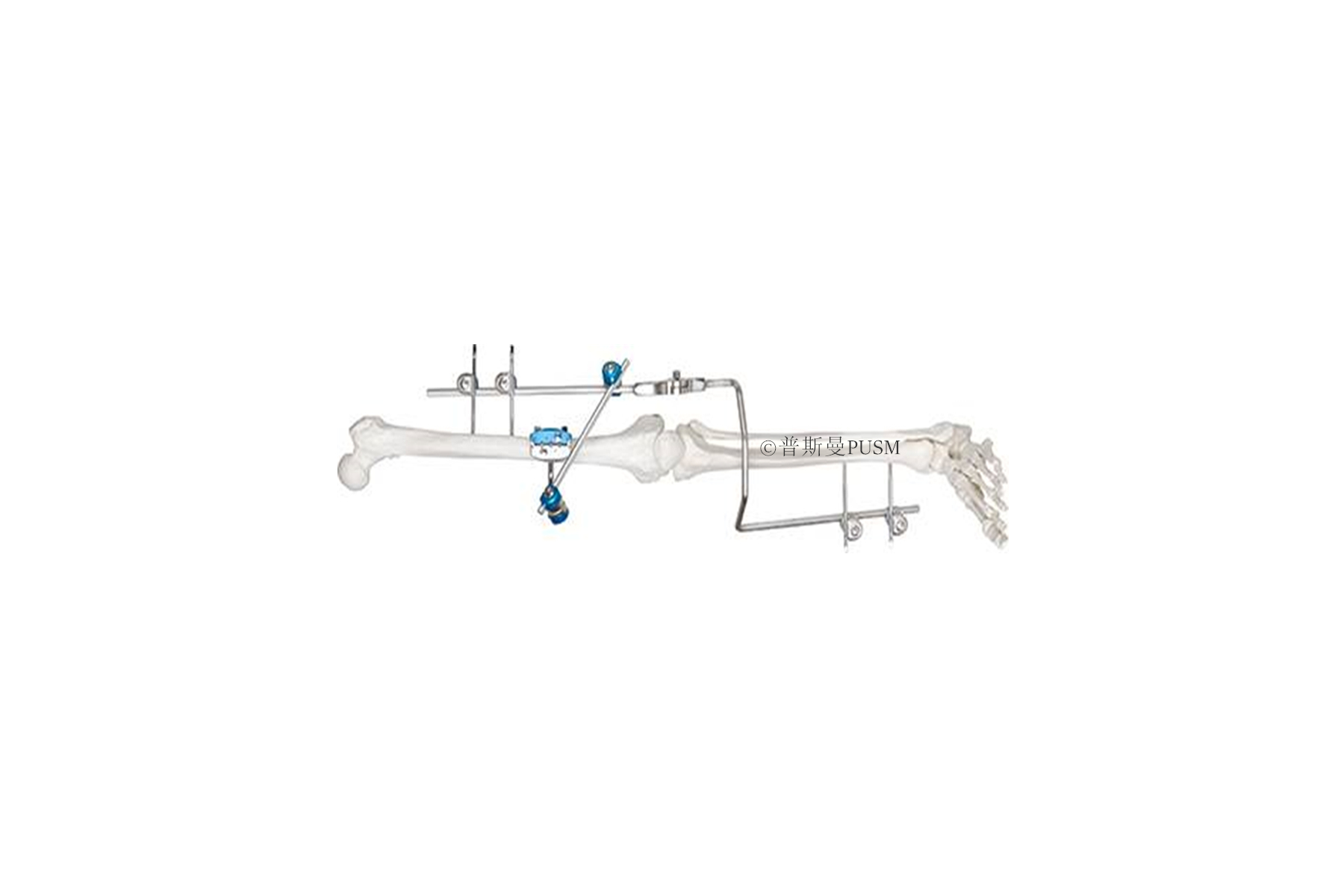 SPUSM-H18 Knee Joint External Fixator