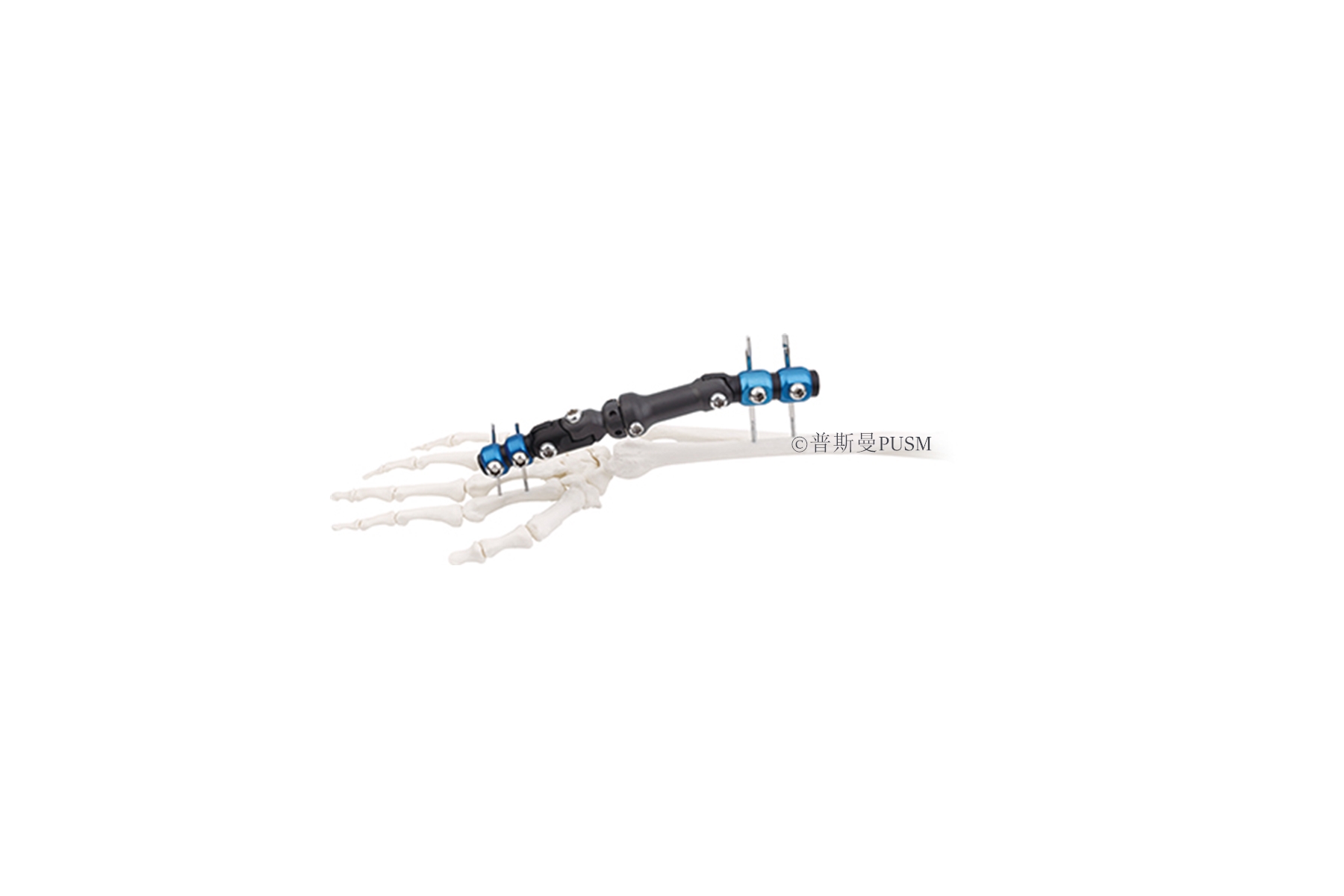 SPUSM-P02 Wrist Joints External Fixator Type H (Rad