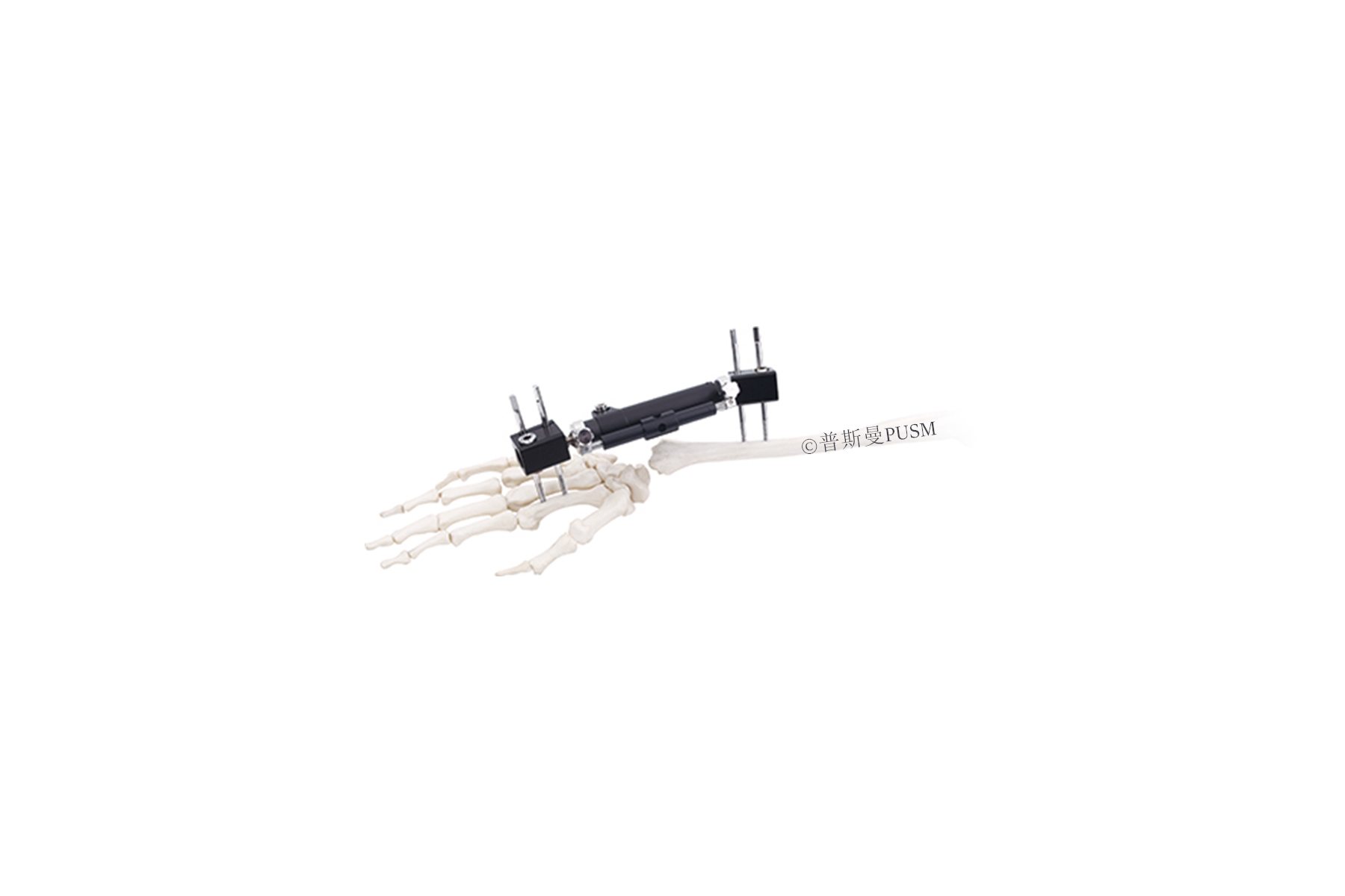 SPUSM-P01 Wrist Joints External Fixator Type G (Rad