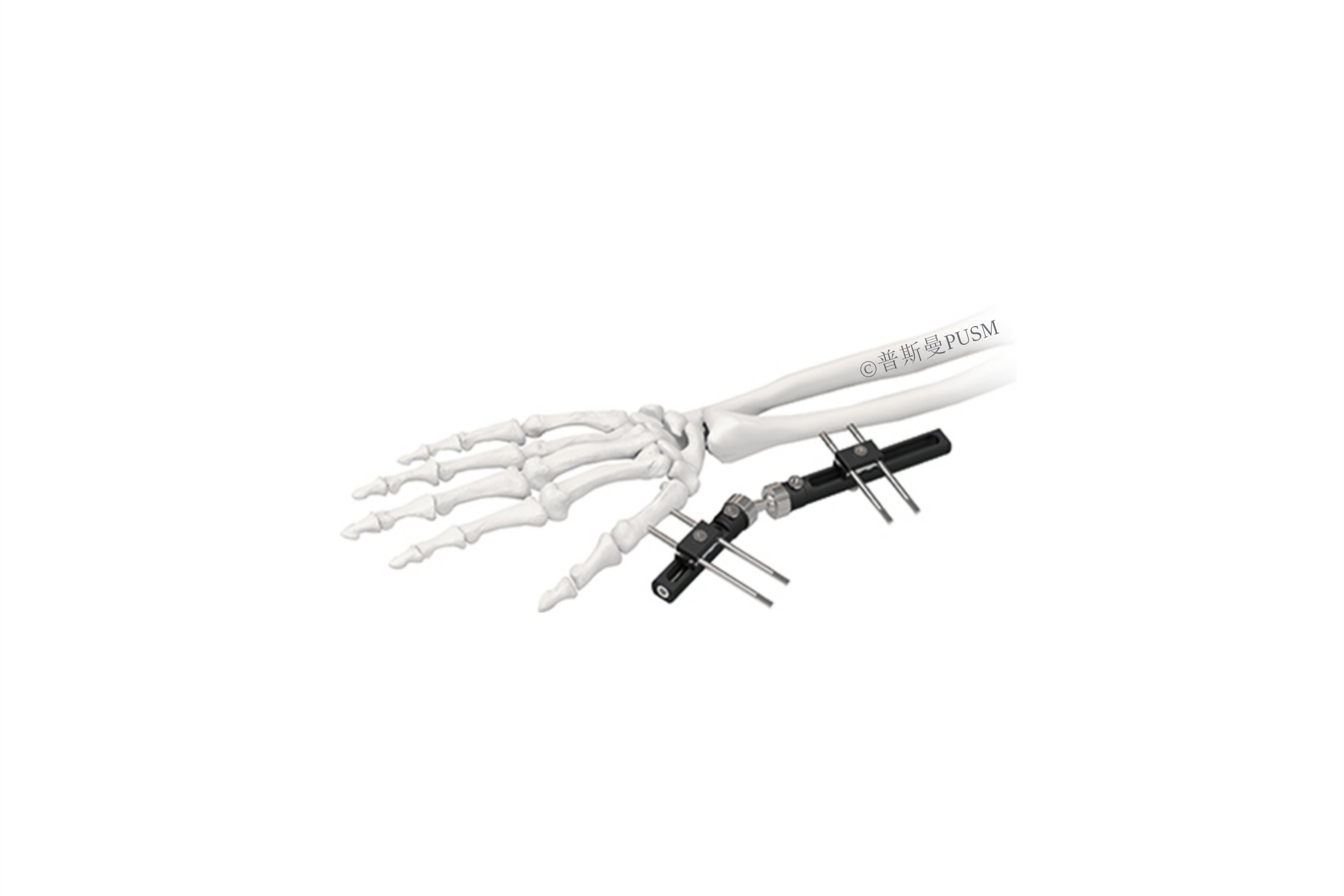 SPUSM-O0204 Wrist Joints External Fixator Type D