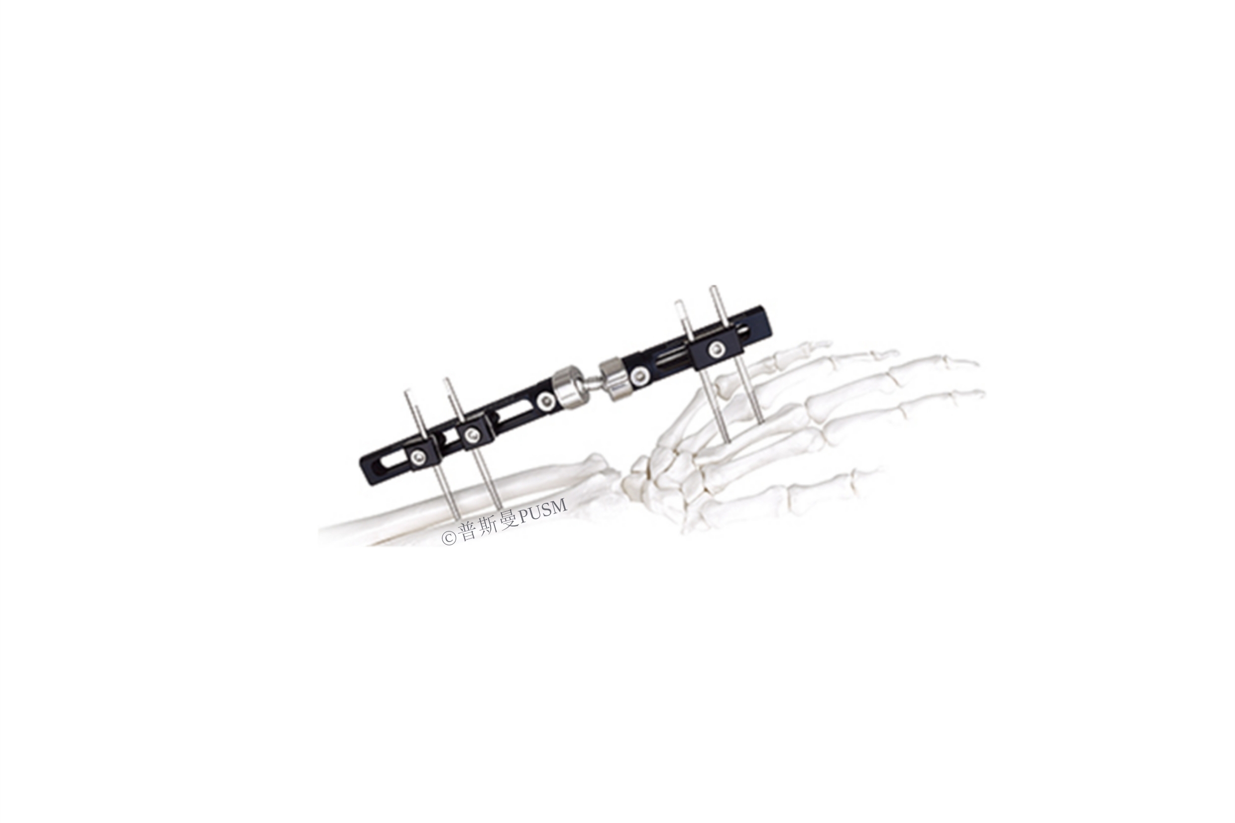 SPUSM-O0205 Wrist Joints External Fixator Type E