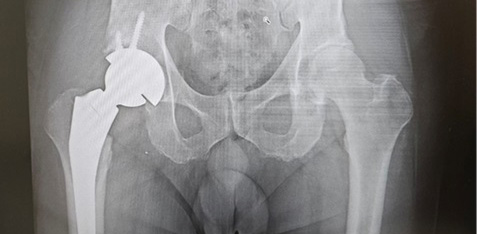 Reverse hip replacement system may have promising 
