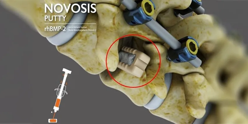 IDE Study Approved for Novel Bone Substitute