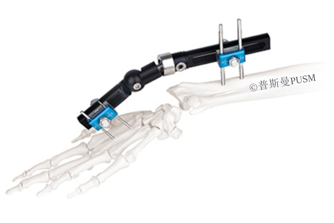 SUlna, Radius, Wrist External Fixator