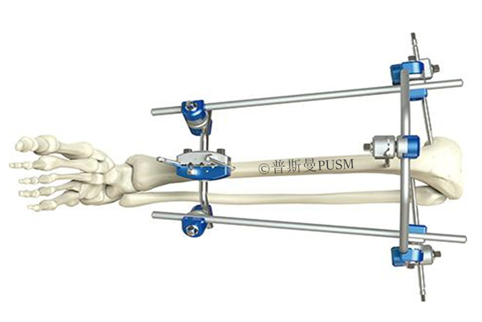 SCombinational External Fixator (A type lower limb)