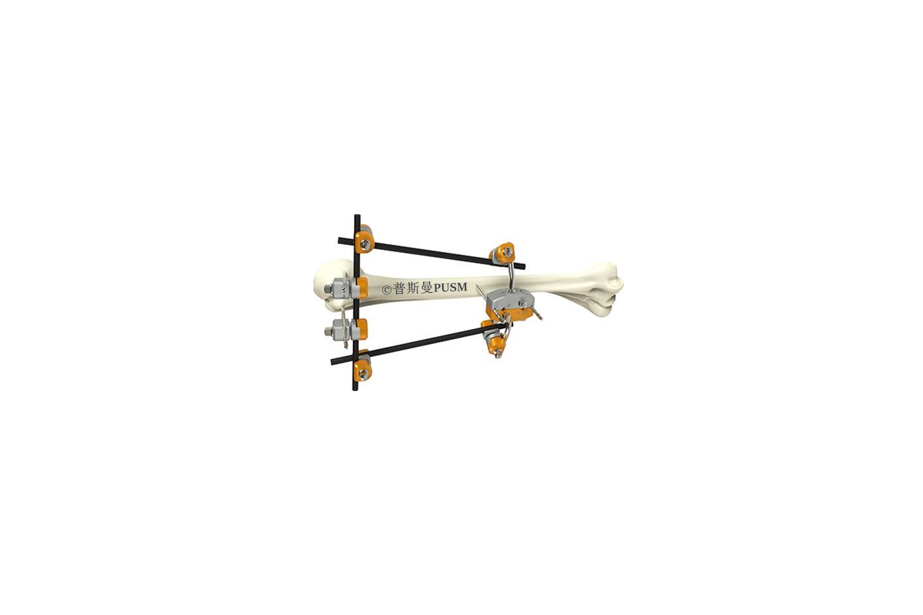 SPUSM-H10 Humeral Shaft External Fixator