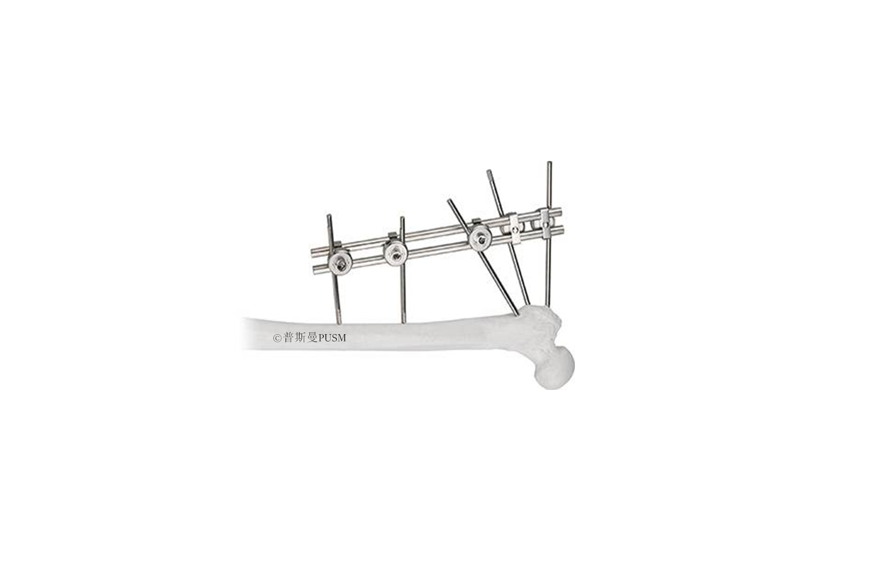 SPUSM-C1801 Pertrochanteric External Fixator