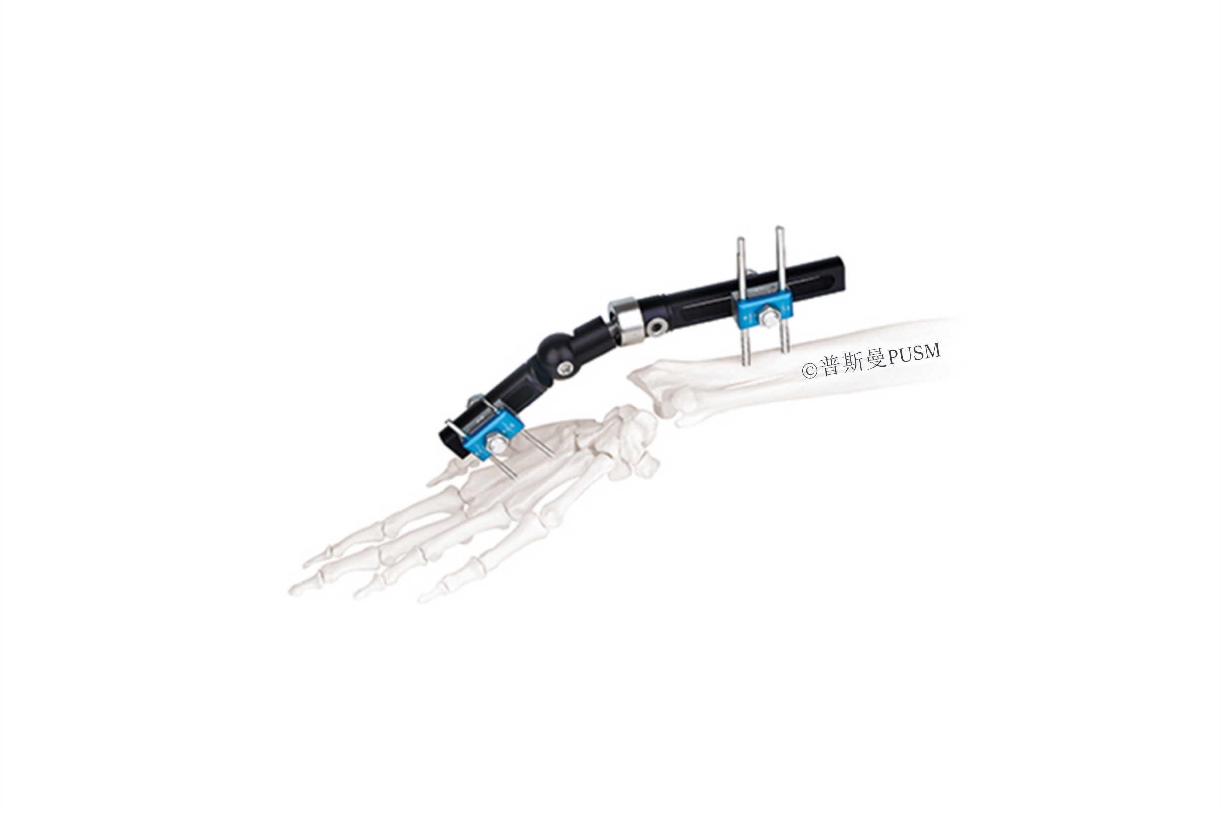 SPUSM-O0202 Wrist Joints External Fixator Type B