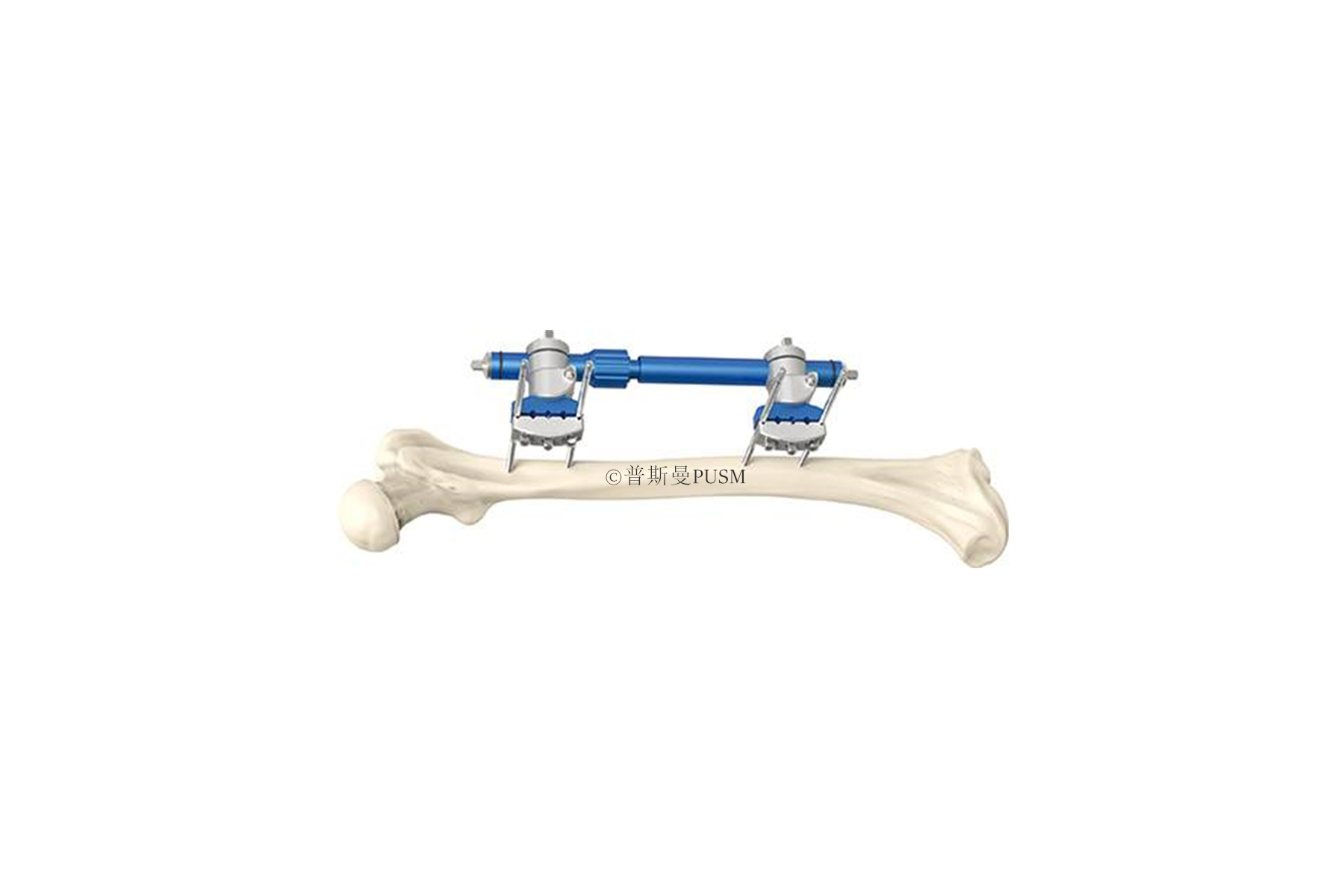 SPUSM-H21 Femoral External Fixator