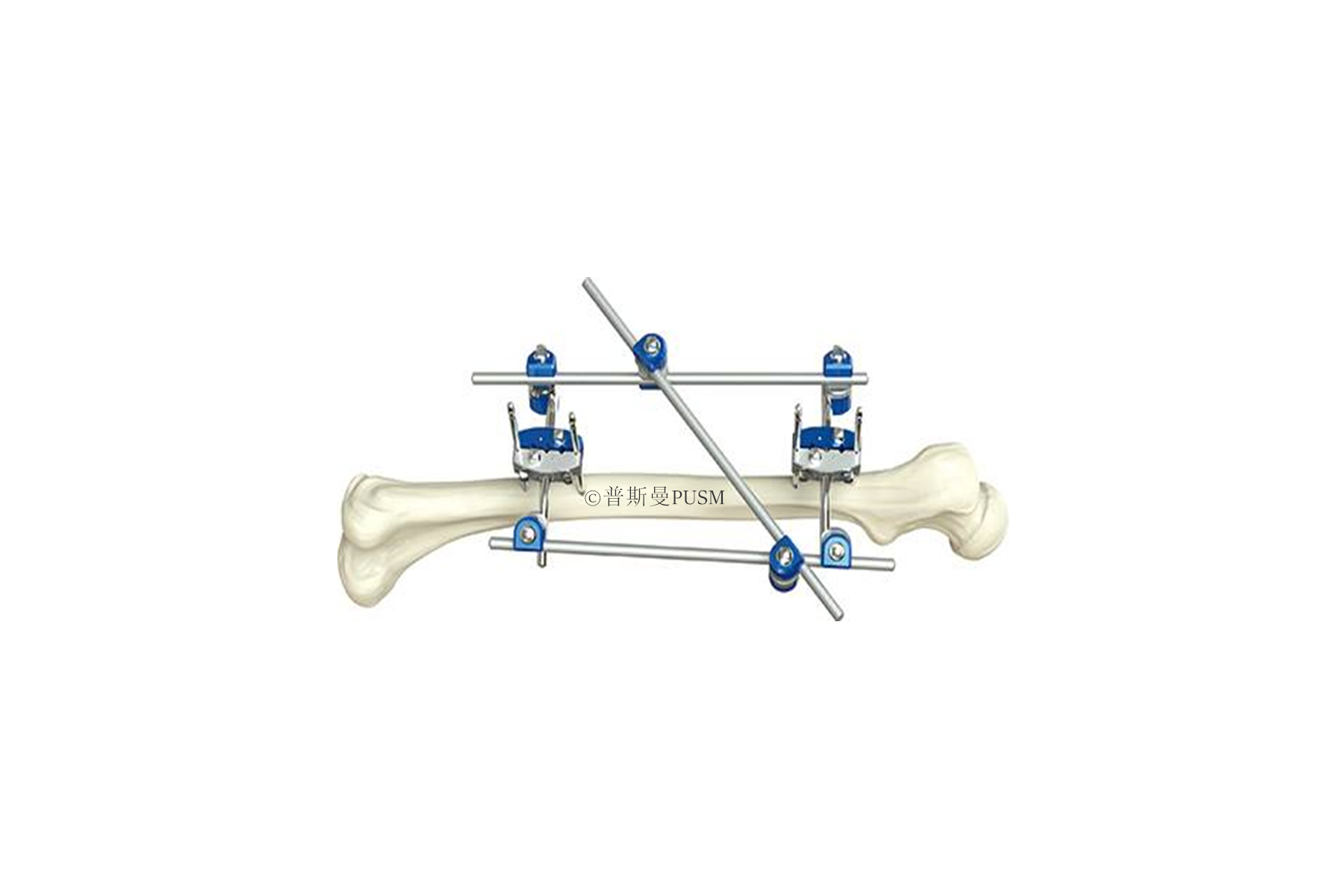 SPUSM-H14 Tibial & Percone External Fixator