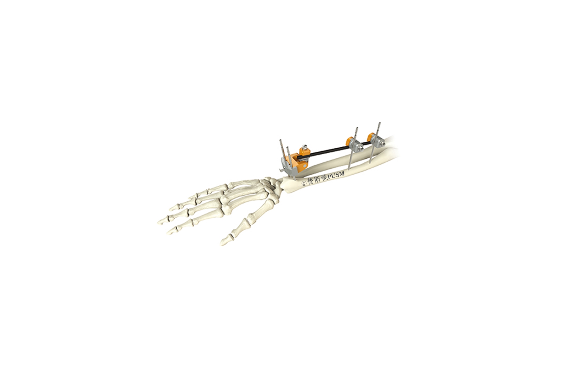 SPUSM-H05 Ulna & Radius External Fixator