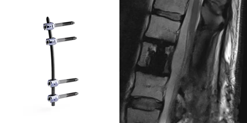 FDA Clears Implants for Spinal Tumors/Infection Re
