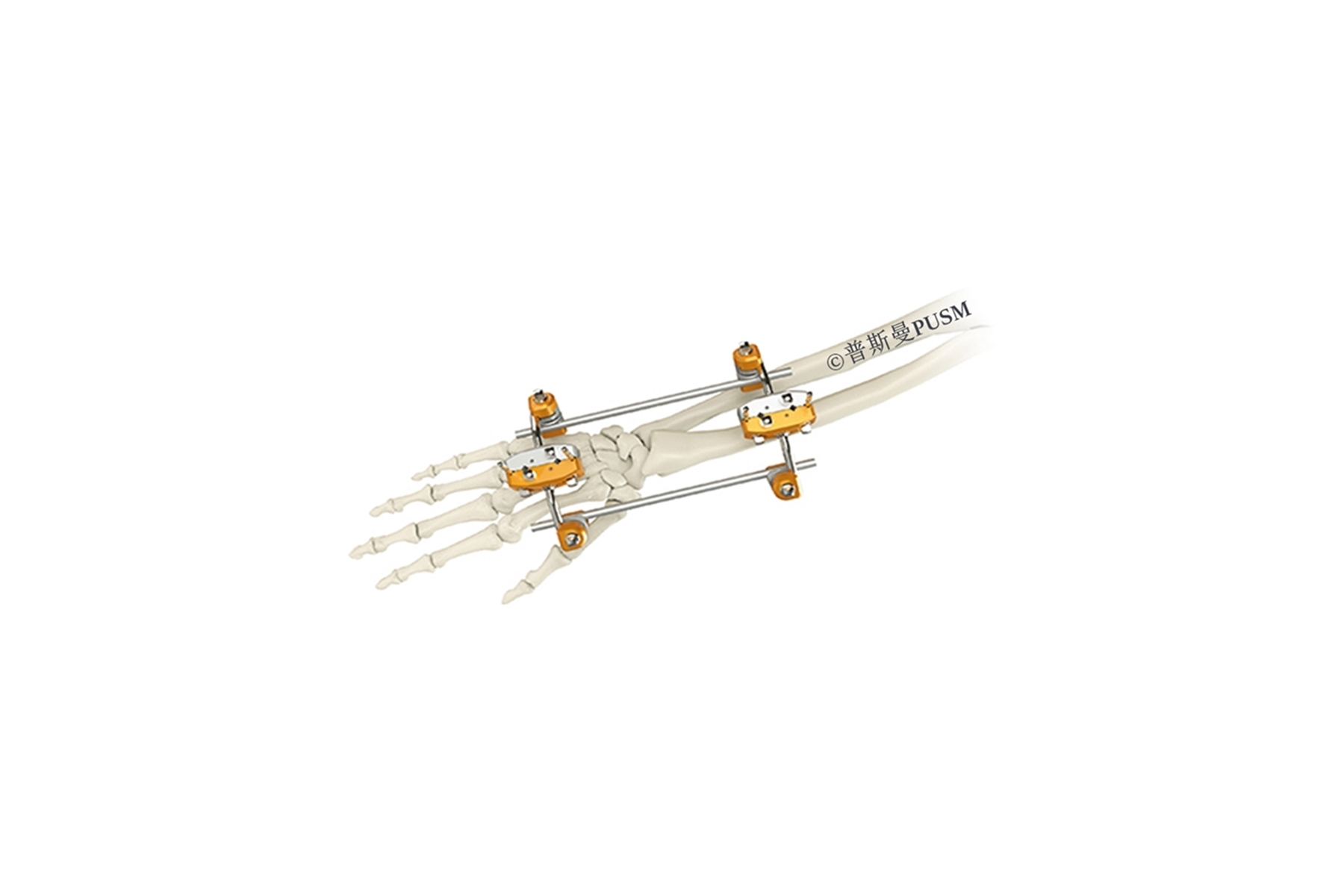 SPUSM- H03 Ulna & Radius External Fixator