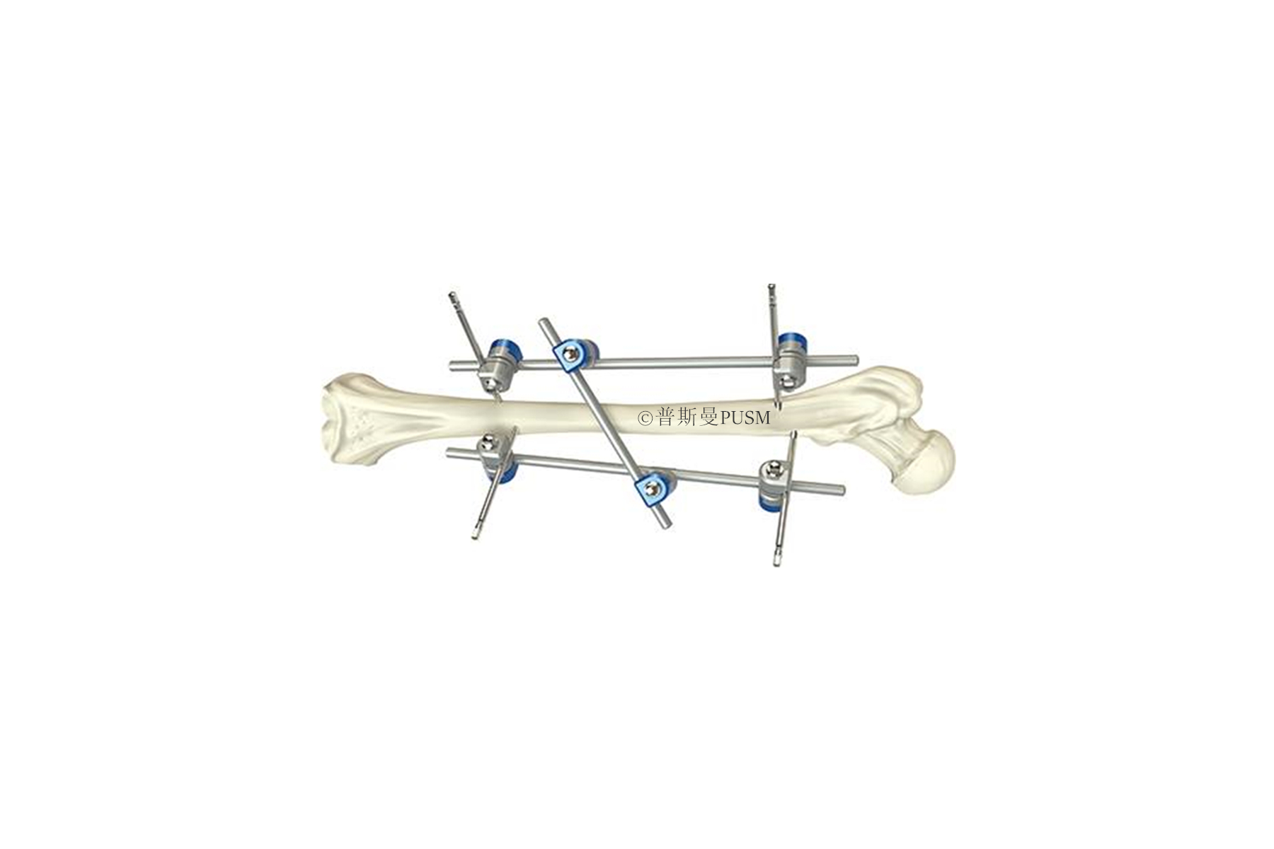 SPUSM-H13 Femoral Shaft External Fixator