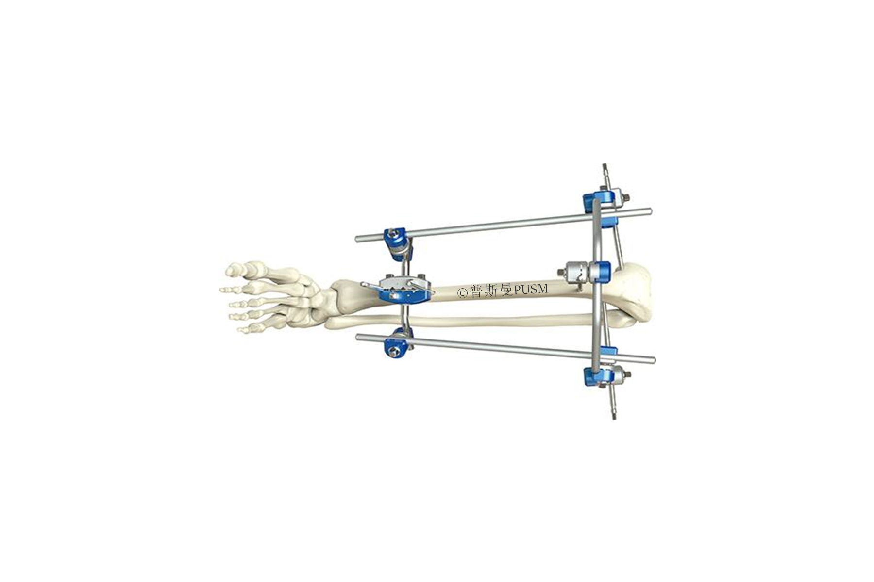 SPUSM-H12 Proximal Tibia External Fixator